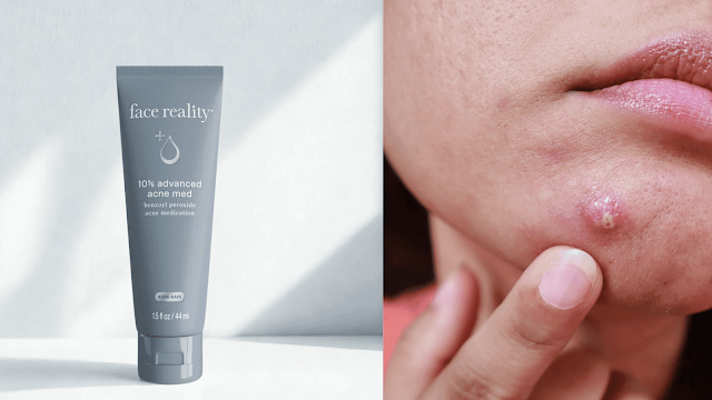 acne in the future of menopause by barbies beauty bits