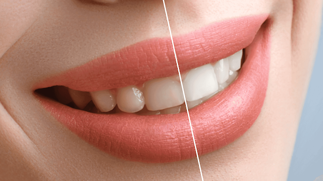 easiest suggestions to acquire your teeth whiter barbies class bits guidelines-for-whiter-teeth-Barbies-Beauty-Bits